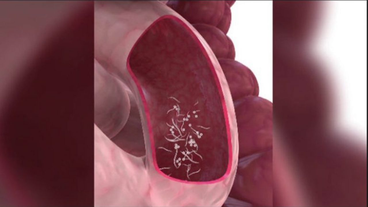 Hpv gebarmutter entfernen. Papilloma virus utero cause Hpv gebarmutter entfernen
