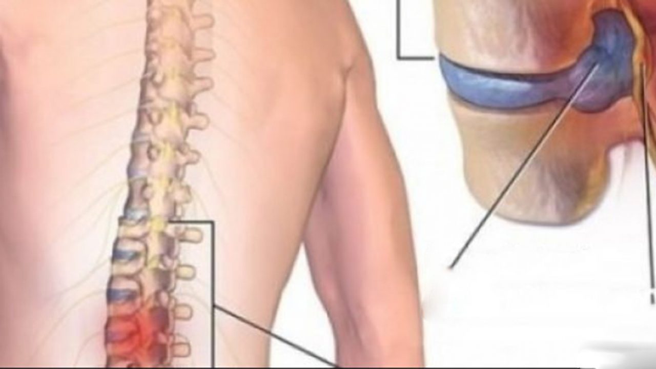 Hernia de disc - Cauze,diagnostic, tratament prin tehnici osteopate