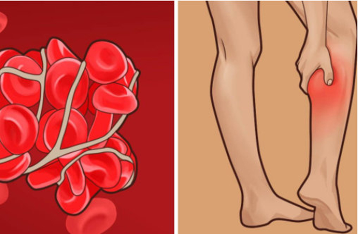 Тромбоз артерии мкб 10. Артериальный и венозный тромбоз.
